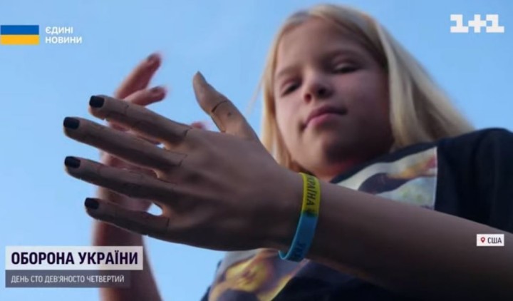 Дівчинка із Гостомеля, якій росіяни відстрелили руку, отримала в подарунок роботизований протез