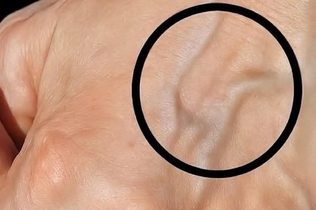 Що означає, якщо у вас випирають вени на руках