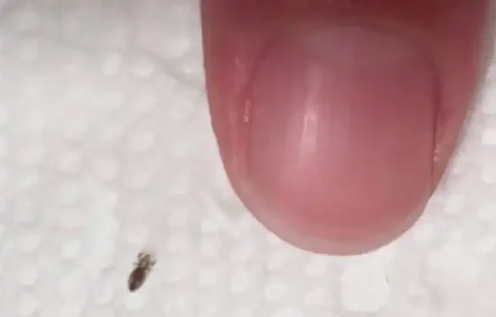 Воші: 10 речей, які потрібно знати про цих маленьких істот