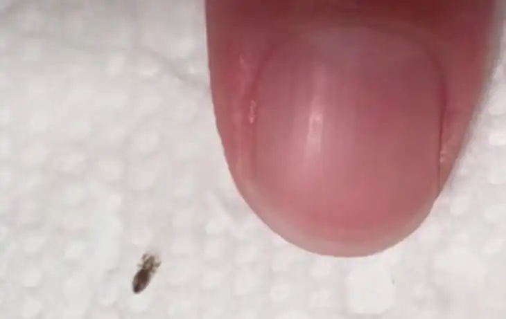 Воші: 10 речей, які потрібно знати про цих маленьких істот